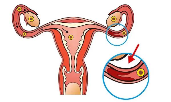 輸卵管堵塞會肚子疼嗎？會覺得不舒服嗎？